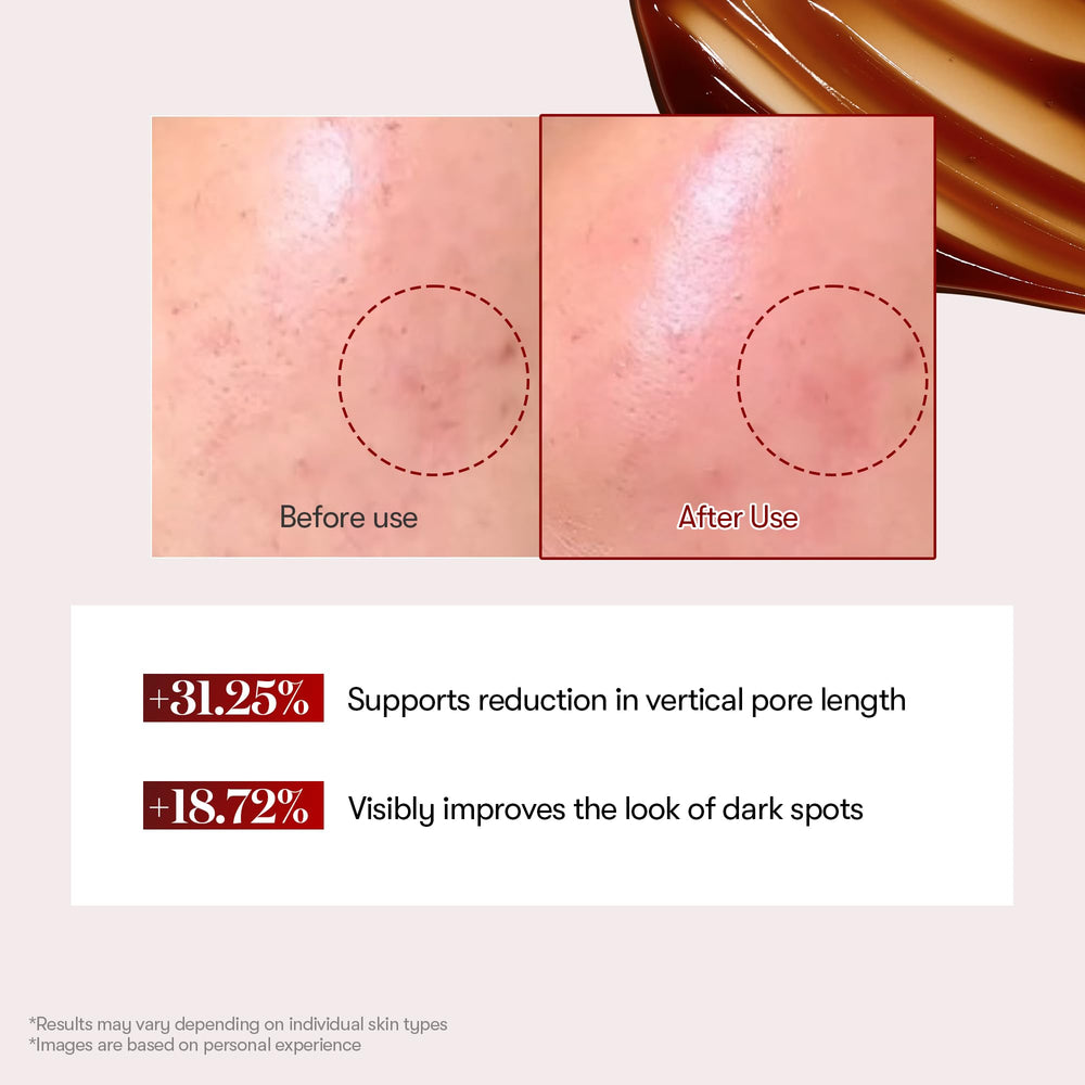 Exosomas microneedling exfolia suavemente la piel