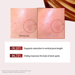 Exosomas microneedling exfolia suavemente la piel