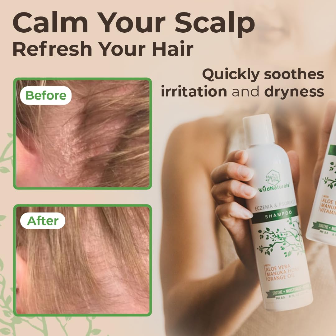 Wild Naturals champú eccema psoriasis: cabello hidratado tras cada lavado