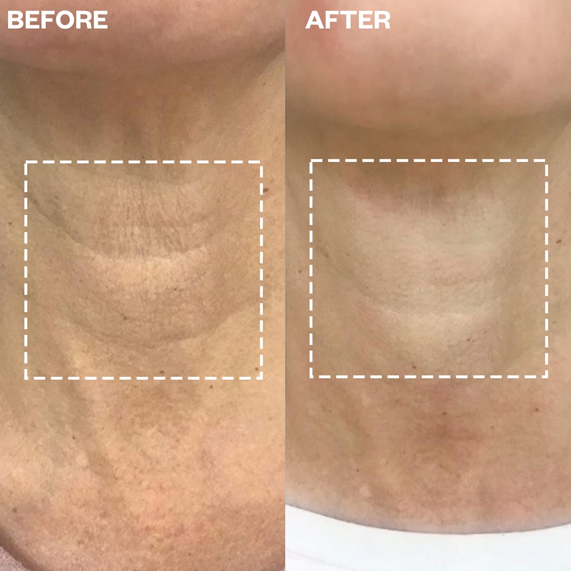 Parche Wrinkles Schminkles de silicona para cuello, acción suave refina líneas horizontales