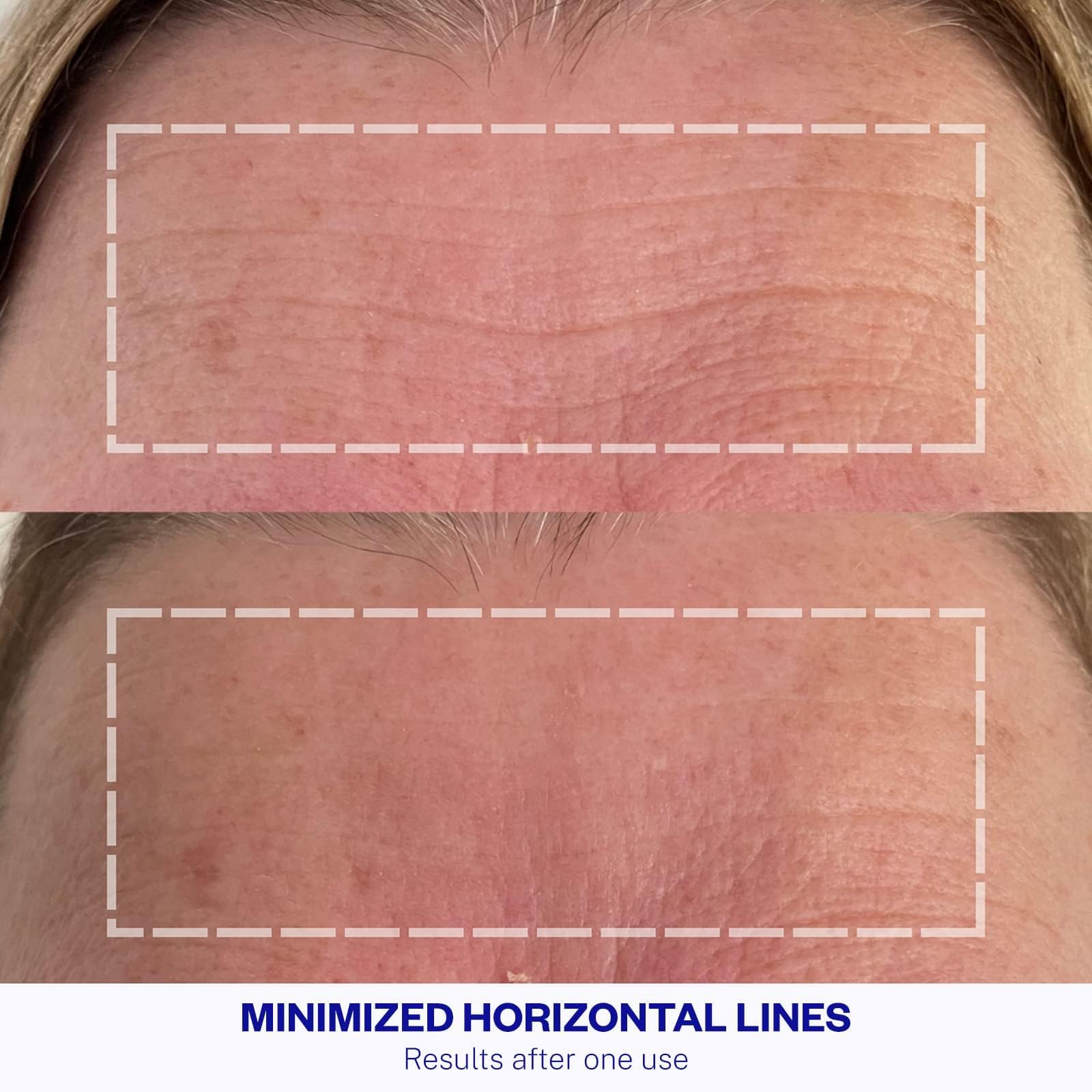 Parche Wrinkles Schminkles frontal adhesión segura para uso nocturno