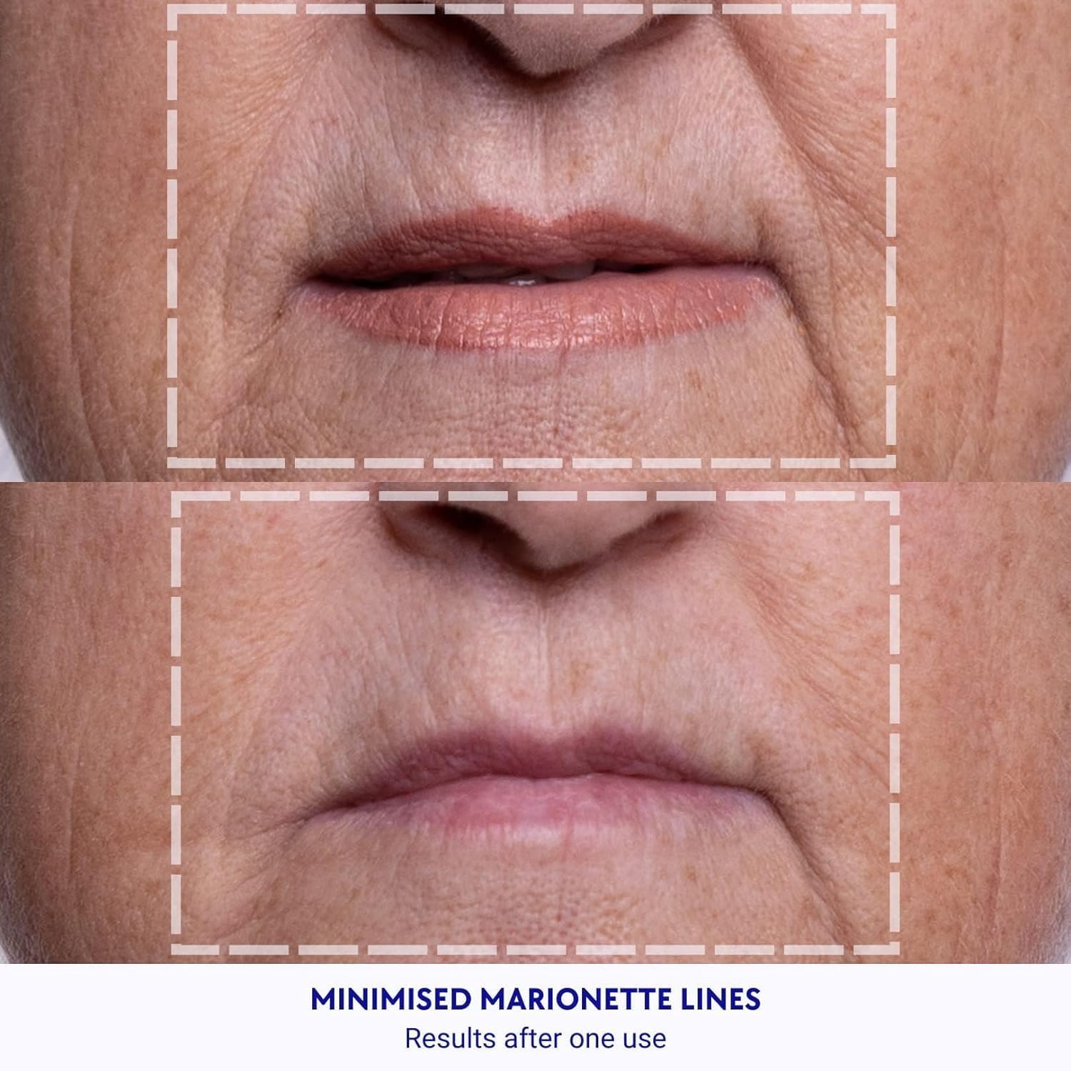 Parches de frente Wrinkles Schminkles para suavizar líneas de expresión.