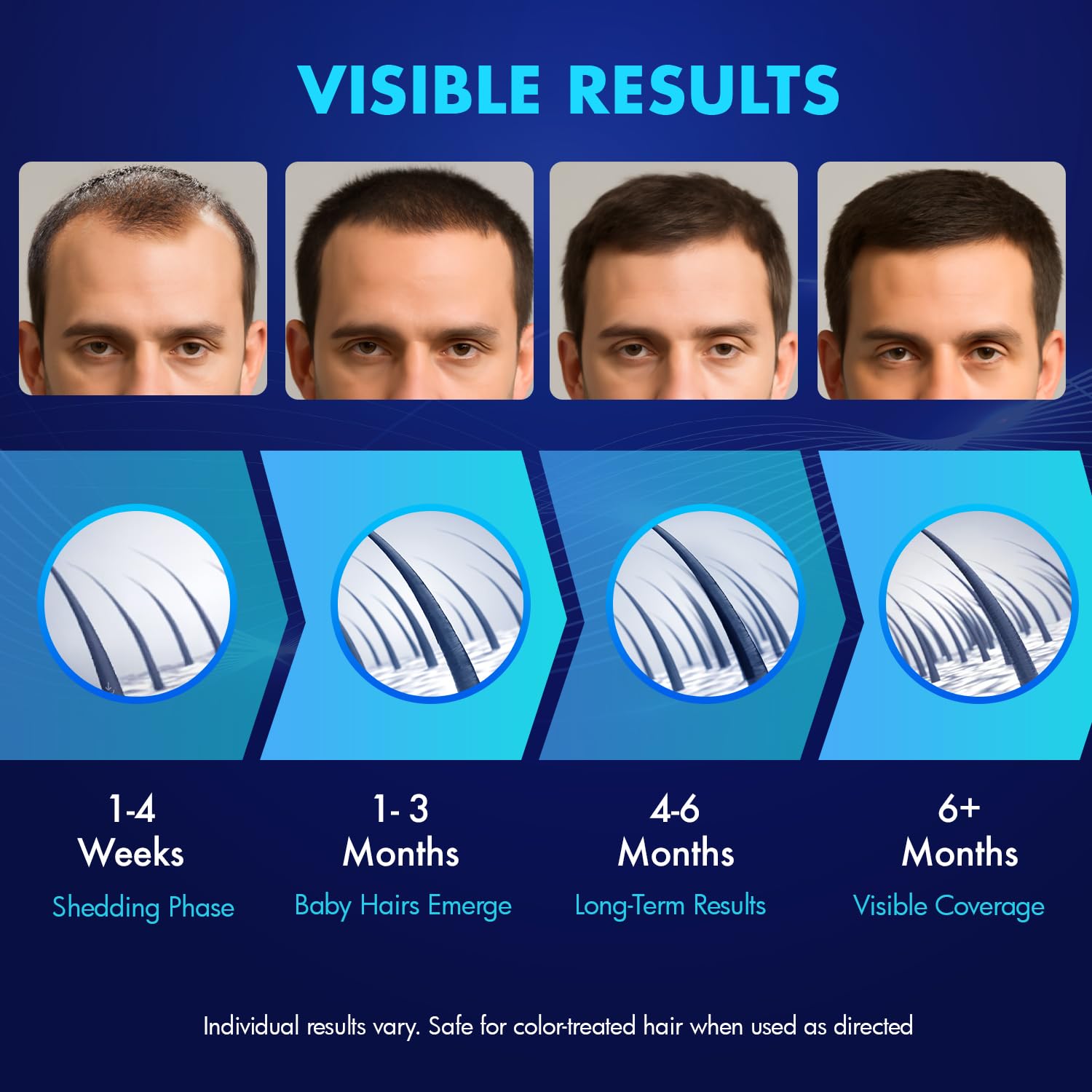 YIIORAUP Rapid-drying Minoxidil formula with oil-free finish after application