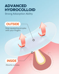 ZATKTK four sizes for different pimples including 8-14 mm
