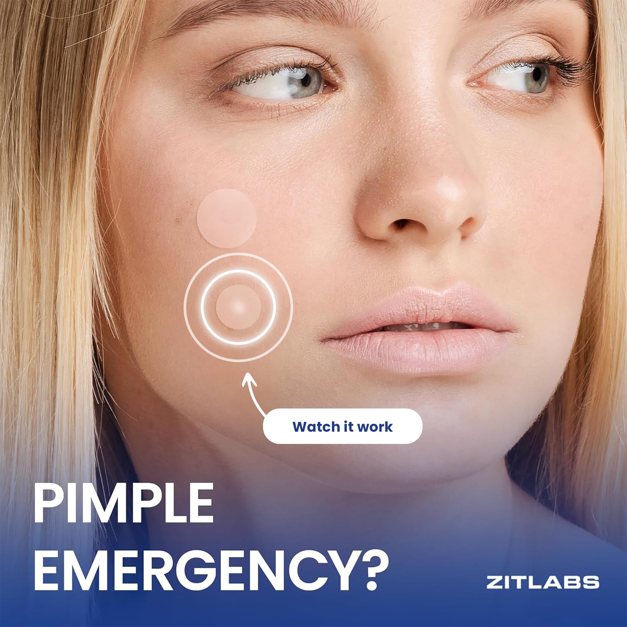 Parche ZitLabs para acne en la piel, absorbe impurezas sin irritar.