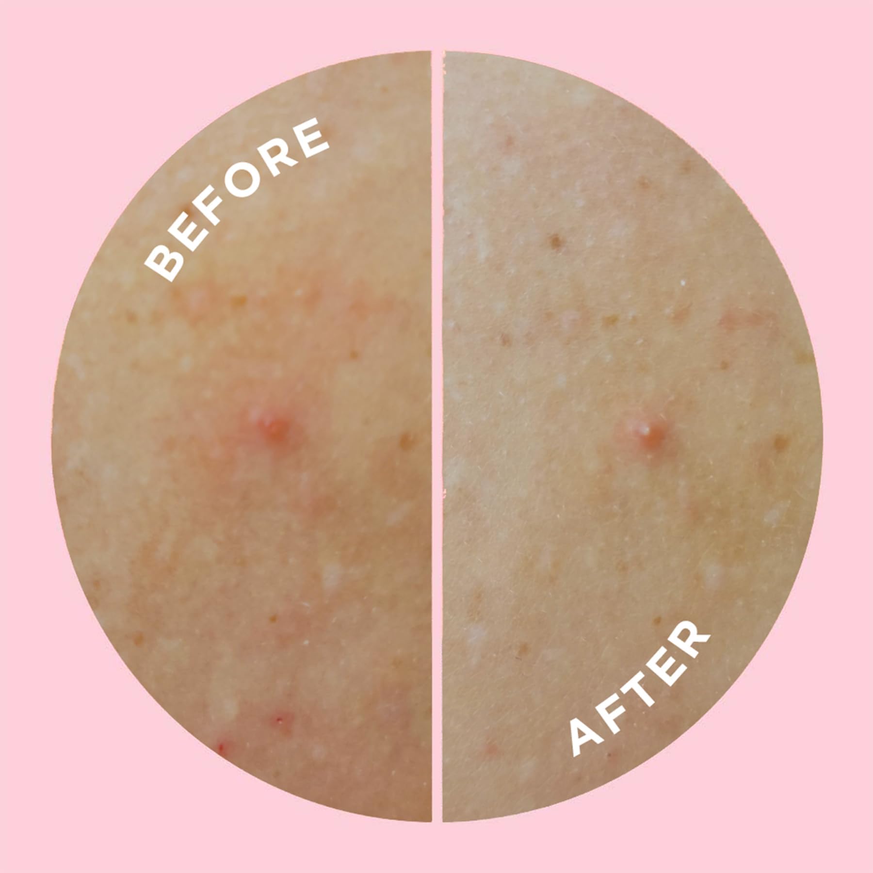 ZitSticka GOO GETTER parche corporal cuidado de piel sin irritaciones.