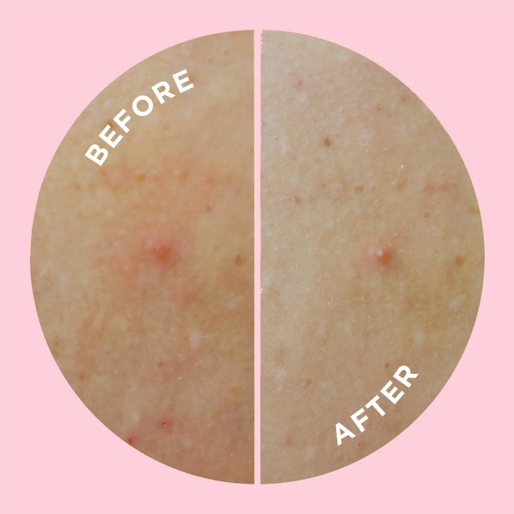 ZitSticka GOO GETTER parche corporal cuidado de piel sin irritaciones.