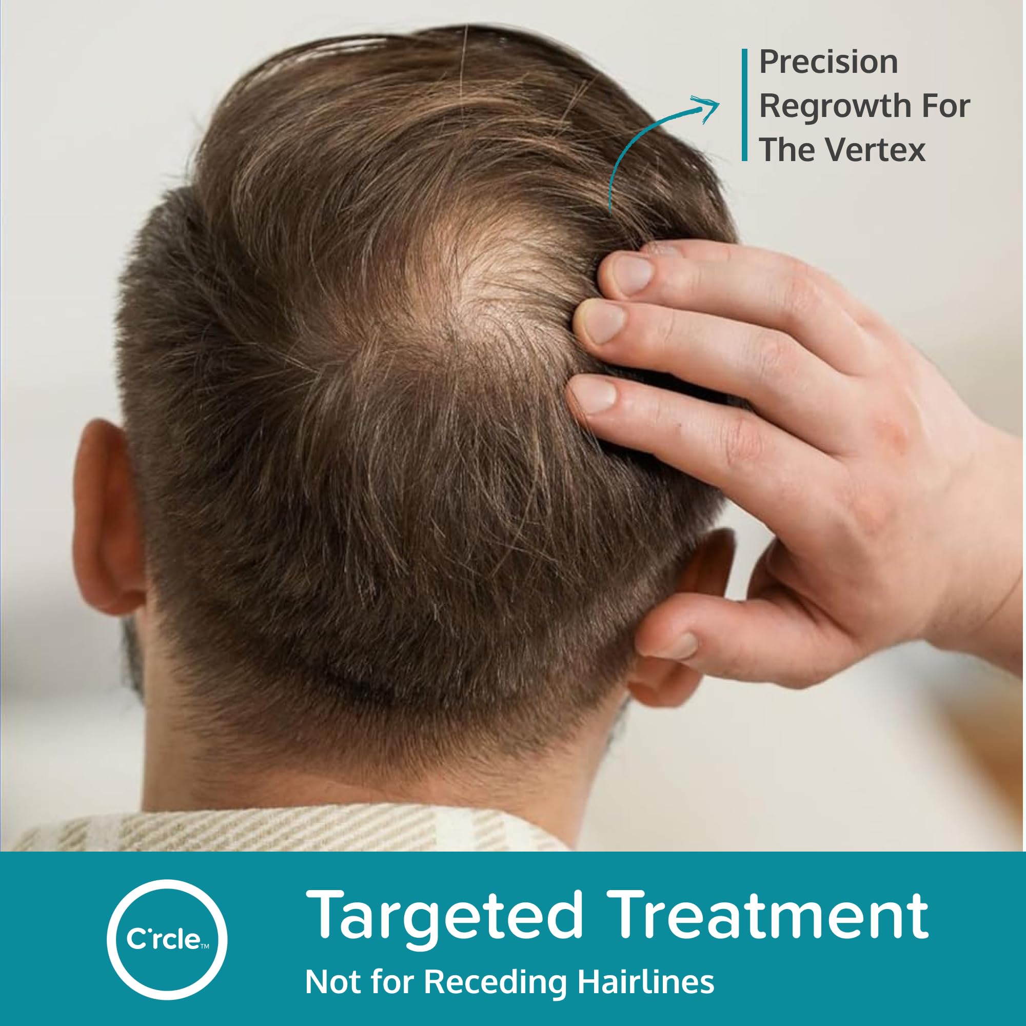 Zonas de coronilla con Minoxidil 5% para hombres