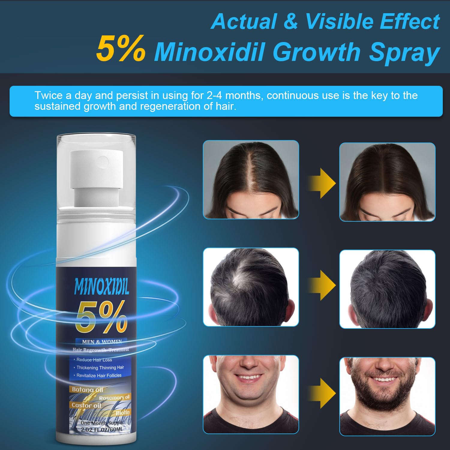 ZYXN Minoxidil 5% de absorción rápida y textura ligera no grasa.