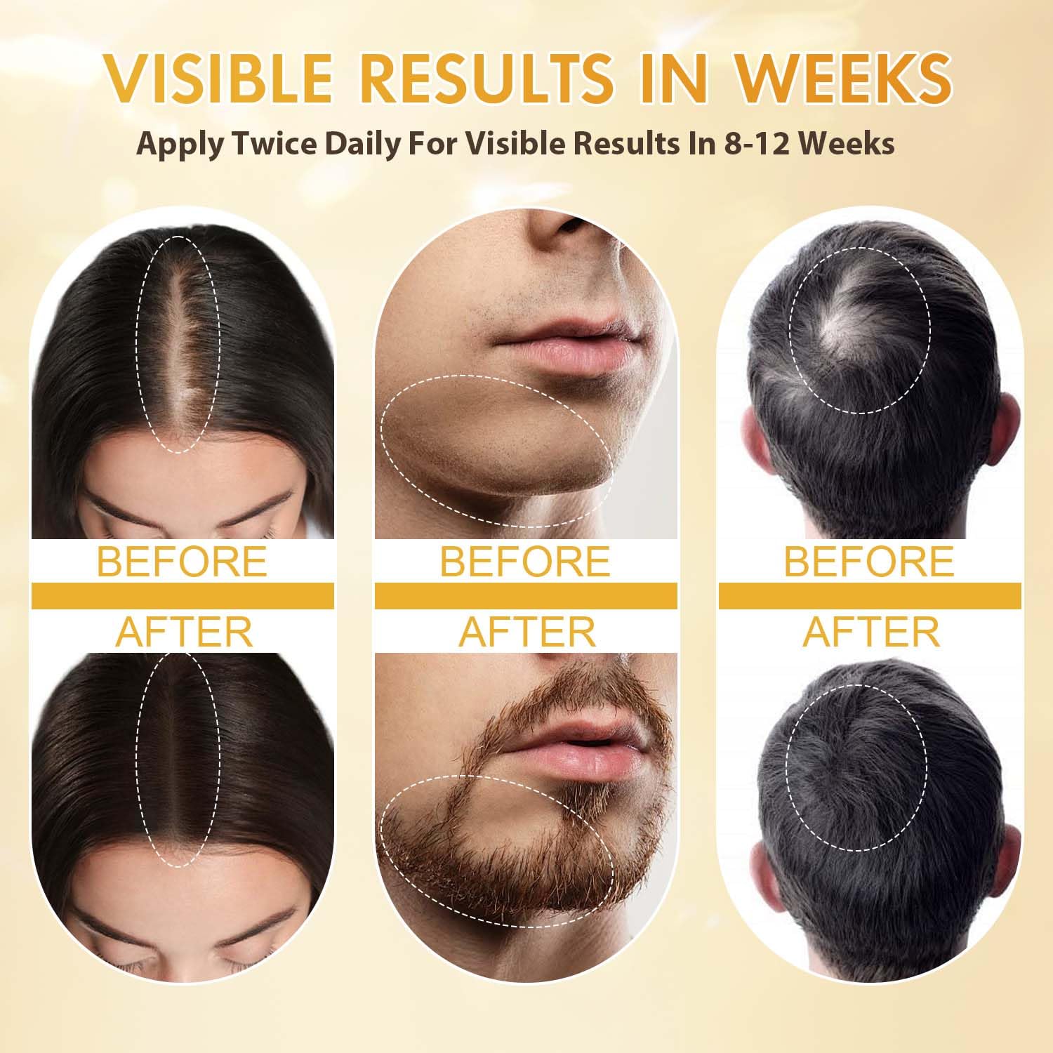 ZYXN Minoxidil favorece la regeneración de vello en la barba