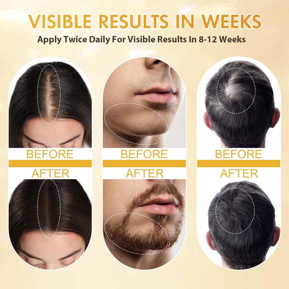 ZYXN Minoxidil favorece la regeneración de vello en la barba